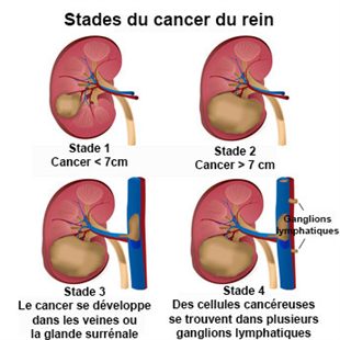 cancer des ovaires personne agee