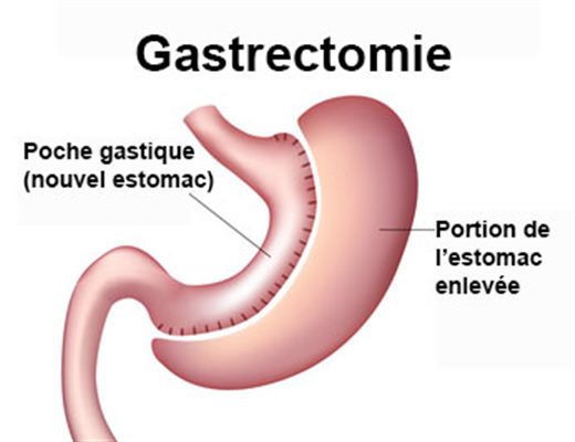 Gastrectomie