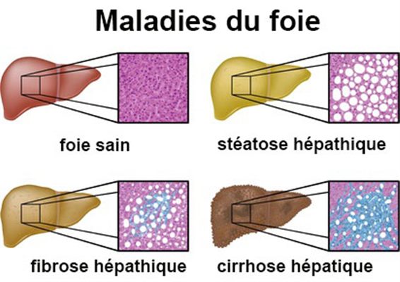 Maladies du foie