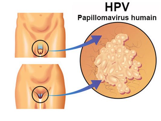 Papillomavirus : des réponses à vos questions