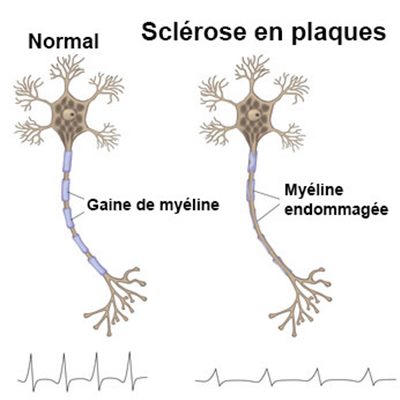 Sclérose en plaque