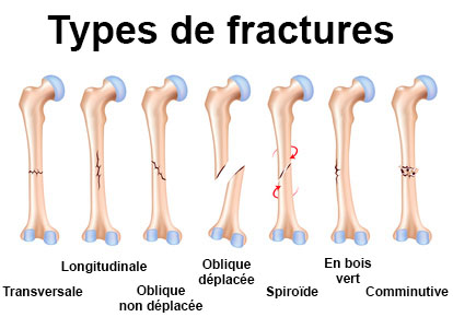 fracture fragments meaning