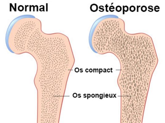 Que faire en cas d'ostéoporose et ostéopénie ?