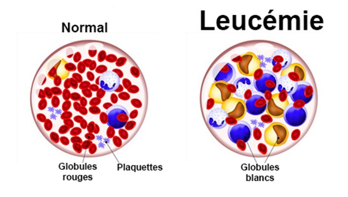Leucémie