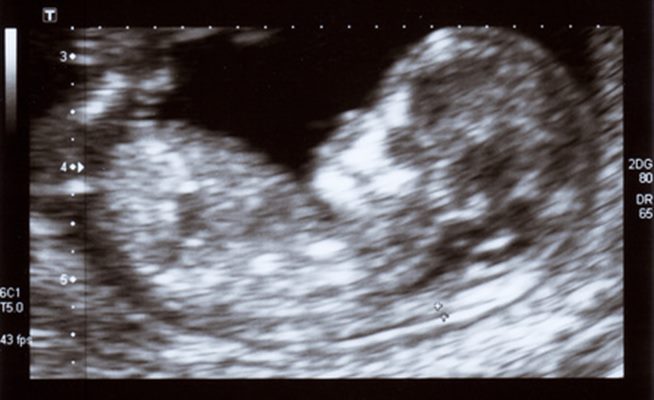 Grossesse, la 3ème échographie de bébé 