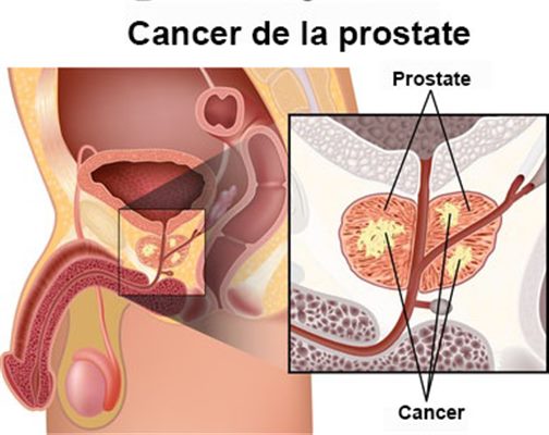 Prostatectomie radicale (ablation de la prostate) à Paris