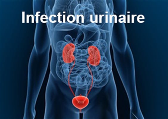 Infection urinaire chez l'homme : symptômes, traitement, définition 