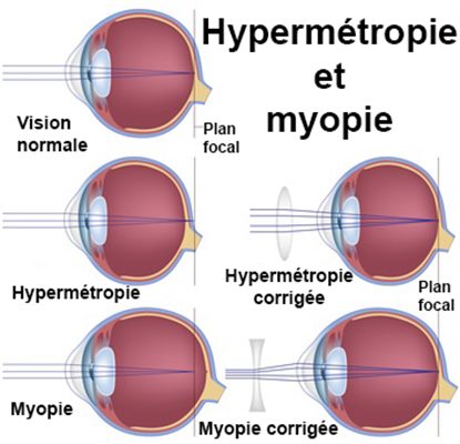 Hypermetropie Symptomes Traitement Definition Docteurclic Com
