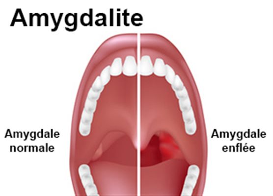 Amygdalite Symptomes Traitement Definition Docteurclic Com