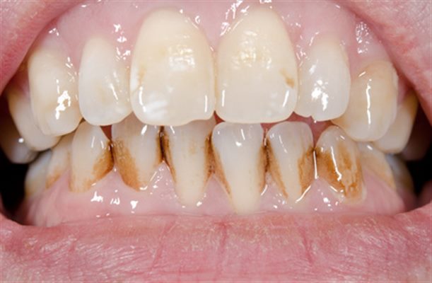 Tartre Dentaire et Détartrage des dents, les causes ? - Tout Dentaire