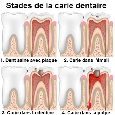 Carie Dentaire Symptomes Traitement Definition Docteurclic Com