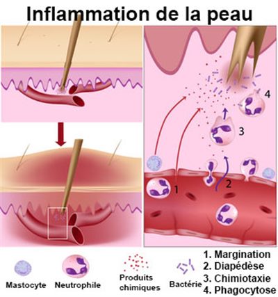Inflammation De La Peau Symptomes Traitement Definition Docteurclic Com