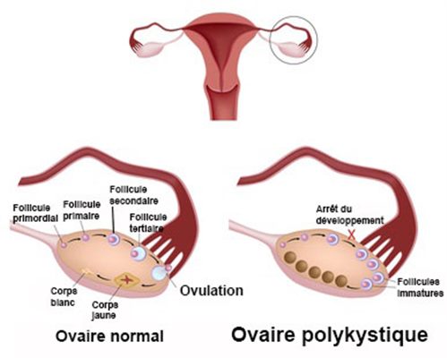 8 signes du syndrome des ovaires polykystiques (SOPK)