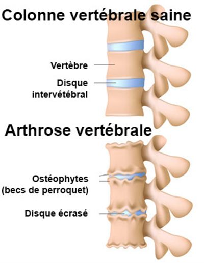 L'arthrose du dos