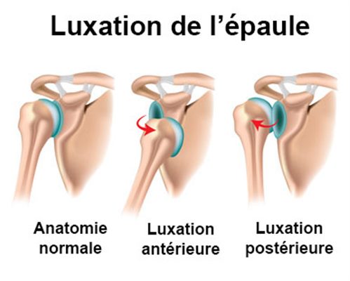 Luxation De L Epaule Symptomes Traitement Definition Docteurclic Com