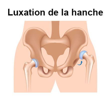 Luxation Congenitale De La Hanche Symptomes Traitement Definition Docteurclic Com