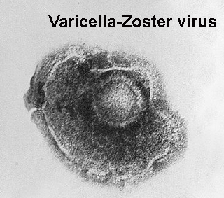 Zona ophtalmique : symptômes, traitement, définition - docteurclic.com