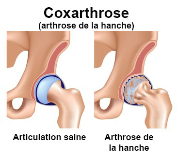 La coxarthrose