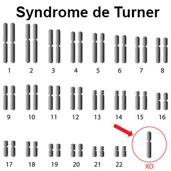 syndrome de Noonan au cou palmé