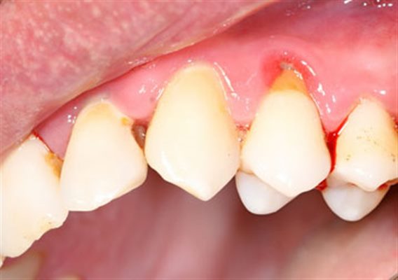 Hemorragie Dentaire Symptomes Traitement Definition Docteurclic Com