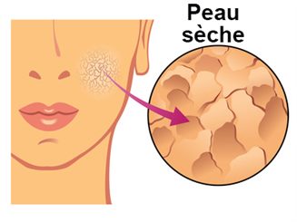 peau sèche