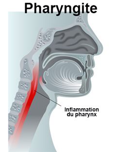 pharyngite