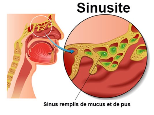 Cancer des sinue et des fosses nasales