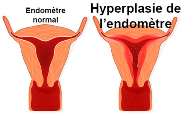 Hyperplasie De L Endometre Symptomes Traitement Definition Docteurclic Com