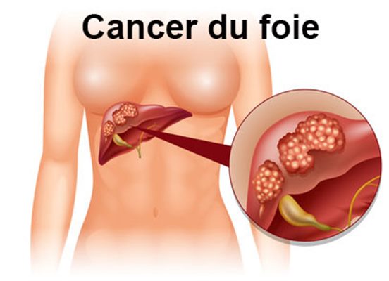 Cancer du foie : définition, causes, traitement