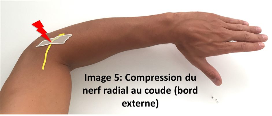 Compression du nerf radial au : -
